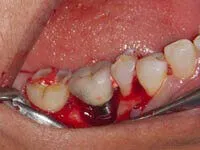 Drug Induced Abscess Flap Surgery Before After peri-implantitis flap surgery treatment results at DentiCare India