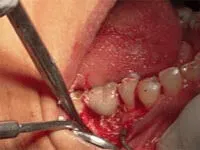 Drug Induced Abscess Flap Surgery Before Before peri-implantitis flap surgery treatment at DentiCare India