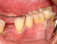 Pre-flap surgery dental condition evaluation at DentiCare India