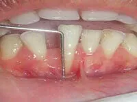 Free gingival graft before treatment showing gum recession