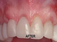After root coverage surgery results showing restored gum line at DentiCare India