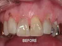 Before root coverage surgery showing gum recession at DentiCare India