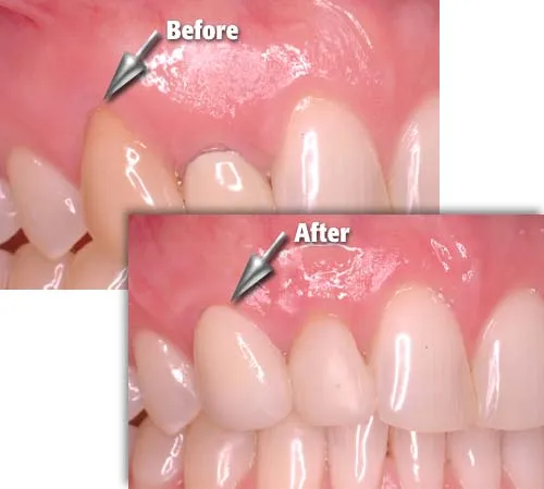 Root coverage surgery procedure overview at DentiCare India