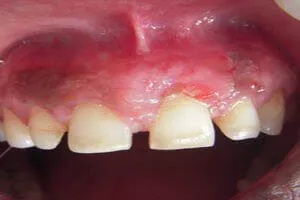 Subepithelial connective tissue graft after healing and tissue regeneration