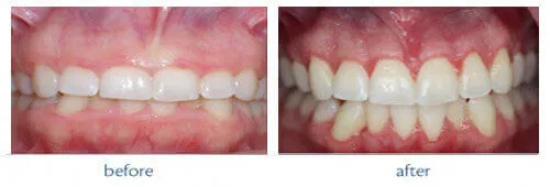 Esthetic crown lengthening periodontal plastic surgery at DentiCare India