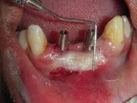 Free gingival graft around dental implants after treatment results at DentiCare India