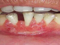 Free gingival graft after treatment results at DentiCare India