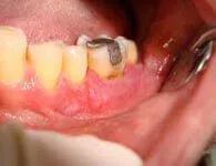 After successful guided tissue regeneration treatment