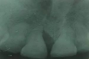 Lost alveolar bone condition before bone grafting procedure